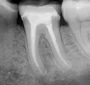 Root Canal Treatment Dentists South Africa
