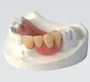 Acrylic Partial Denture Service In South Africa