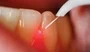 Soft Tissue Laser Dental Services In South Africa
